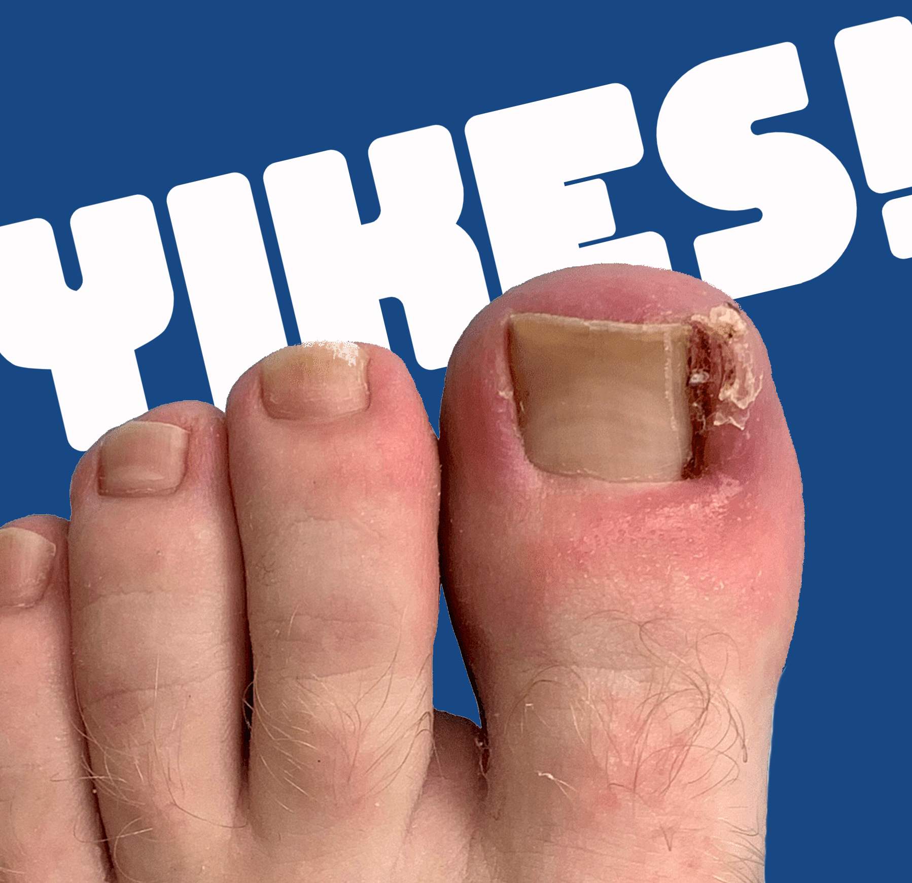 Infected Ingrown Toenails | completely new to running?