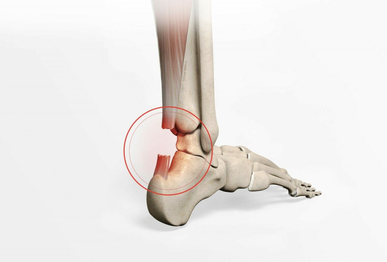 Injury To The Achilles Tendon