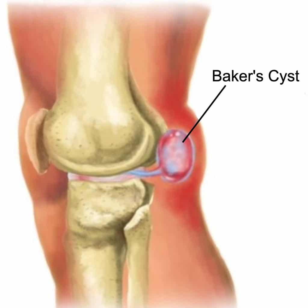 baker's cyst