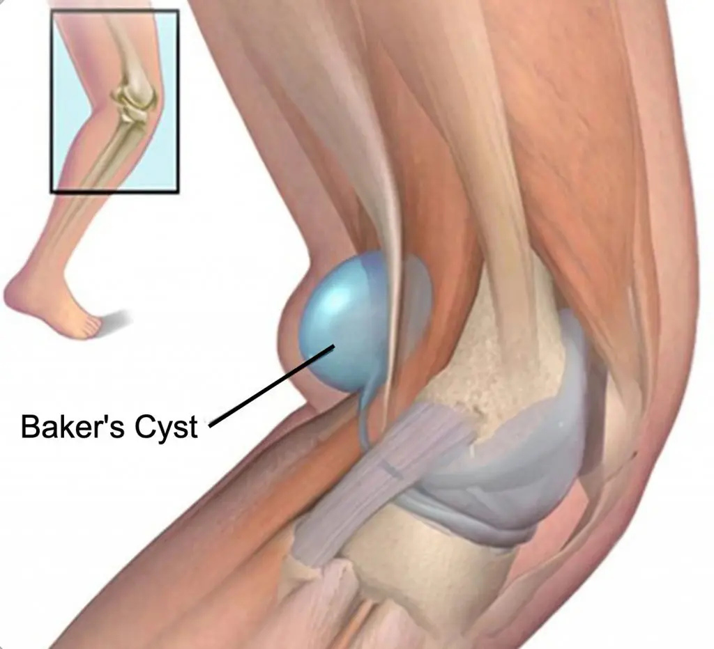 bakers cyst